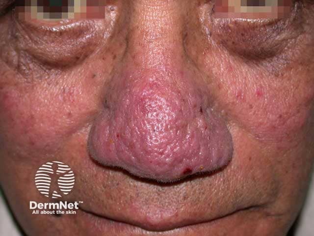 Swelling of the nose due to rhinophyma