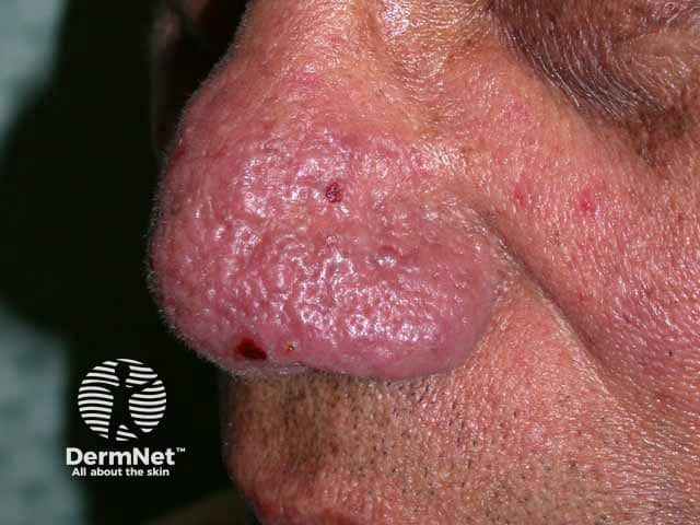Rhinophyma showing swelling and sebeceous gland openings