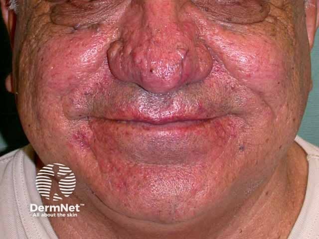 Rhinophyma and papular rosacea on the chin