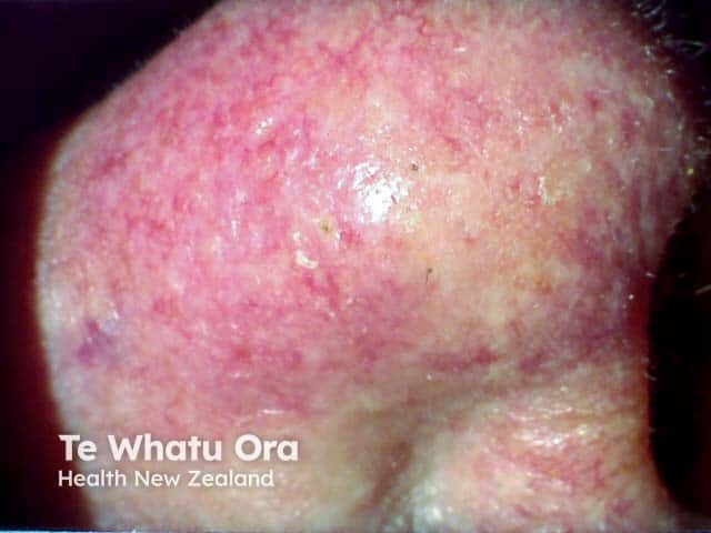 Papules, pustules and telangiectasia in a rhinophyma