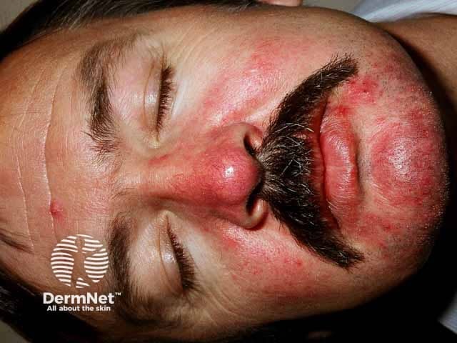 Erythematotelangiectatic rosacea on the nose cheeks and chin