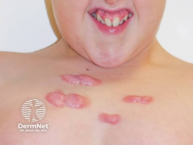 Upper chest keloids; note the facial dymorphic features and charcteristic grimace