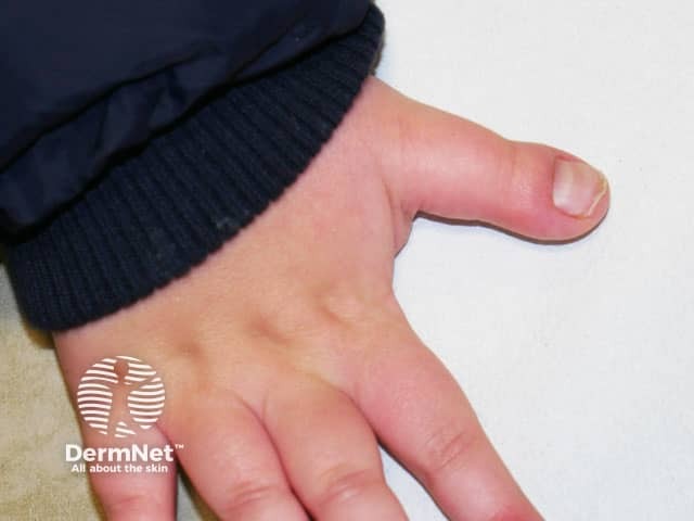 The broad thumb seen in Rubinstein-Taybi syndrome