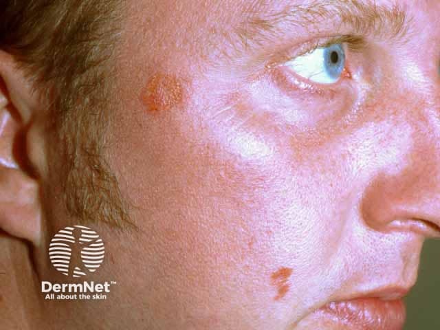Orange-coloured plaque sarcoid of the cheek