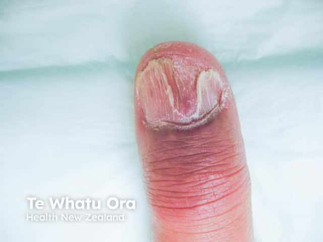 Sarcoid nail dystrophy