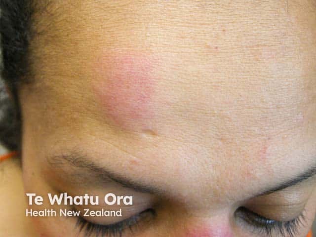 Plaque sarcoid on the forehead