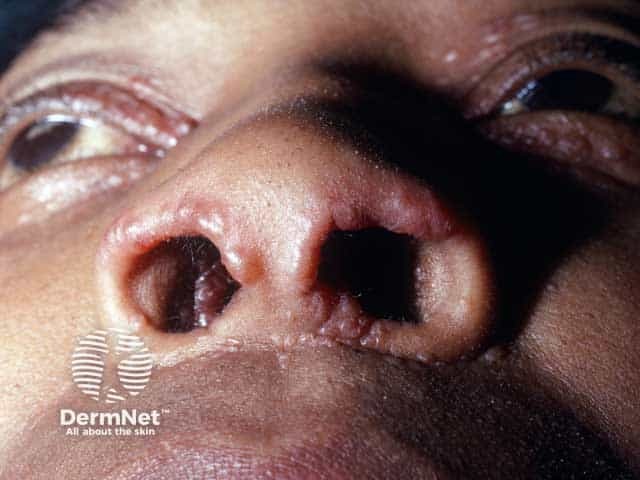 Nasal rim sarcoid papules