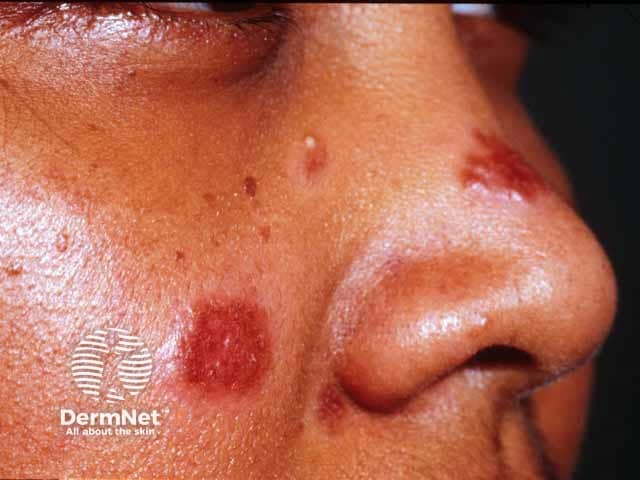 Plaque sarcoid on the cheek and nose