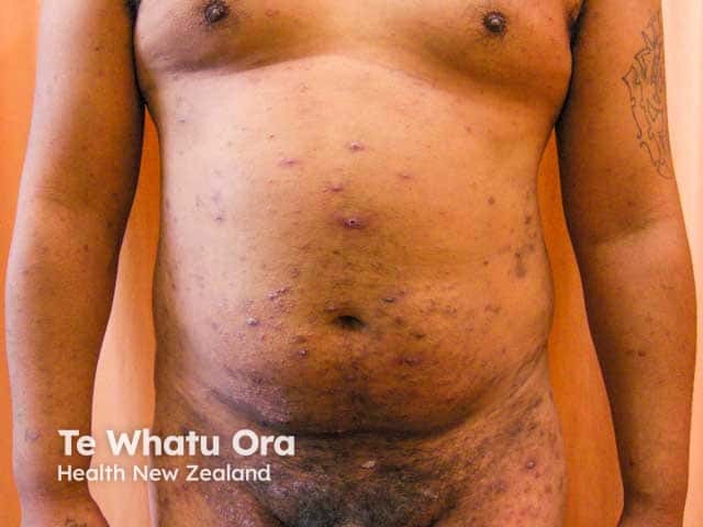 Groin and abdominal papules and pustules in scabies