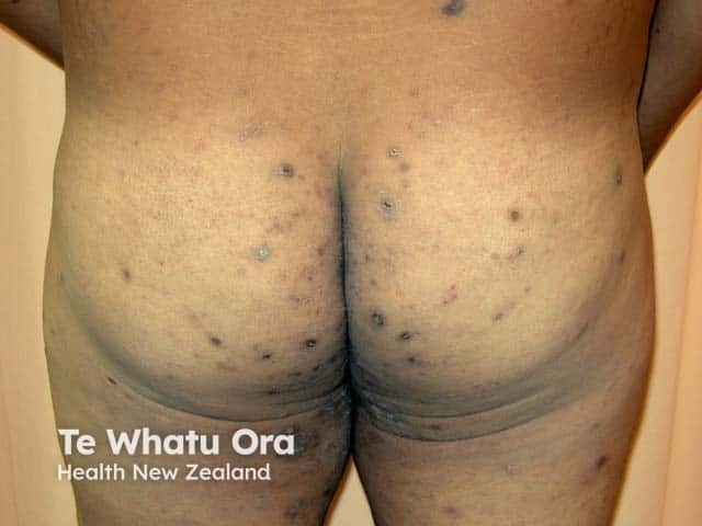 Scabies nodules on the buttocks