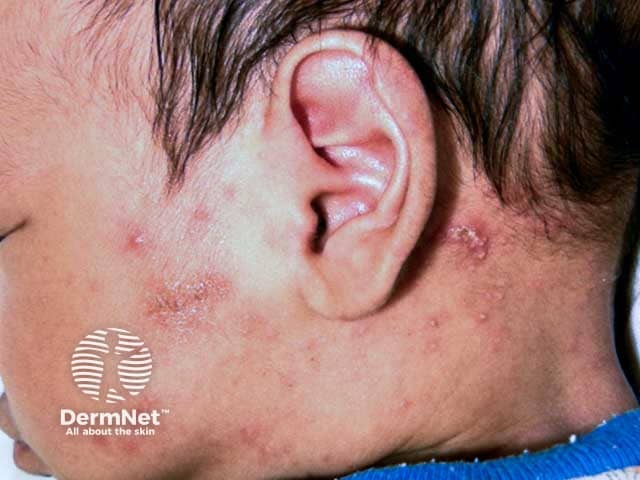 Scabies affecting the neck and face in an infant