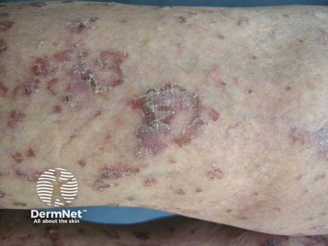Limb lesions in crusted scabies