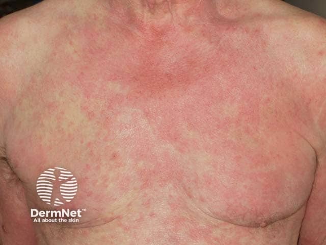 A non specific secondary eruption due to scabies