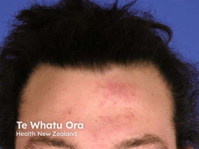 Forehead lesions due to crusted scabies on the body