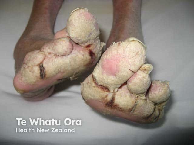 Gross hyperkeratosis in crusted scabies on the feet