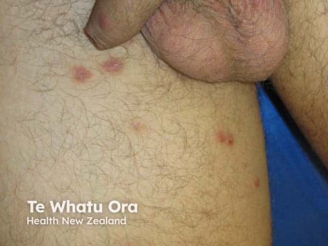 Scabies nodules on the foreskin and thighs