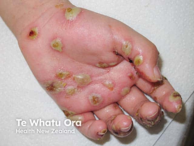 Scabies with superadded streptococcal infection