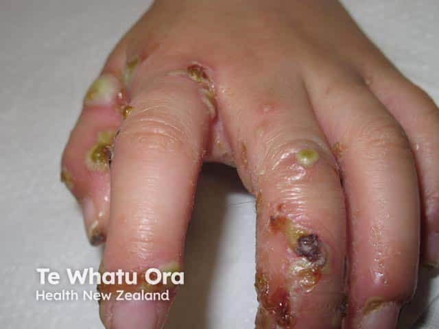 Pyococcal infection of scabies on the hand