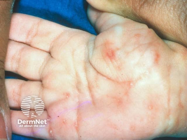 Burrows, vesicles and pustules on the palm in childhood scabies