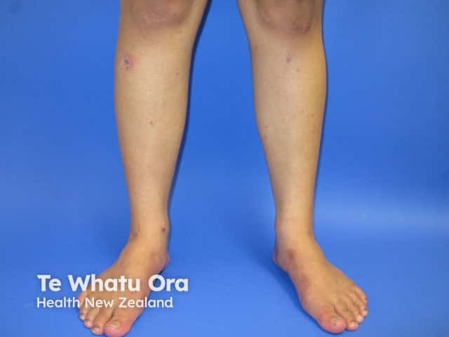 Papules and nodules on the limbs in scabies