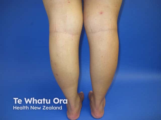 Infected lesions on the limbs in scabies