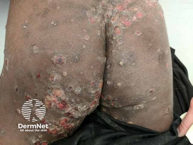 Scabies nodules, some ulcerated over the buttocks with secondary bacterial infection