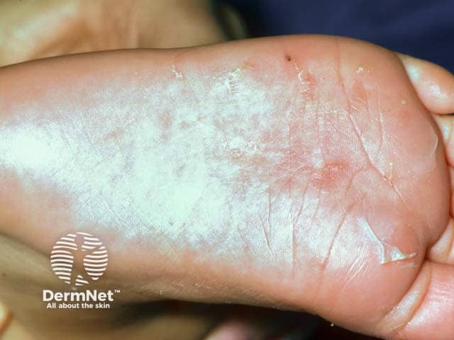 Scabies burrows on a babies foot