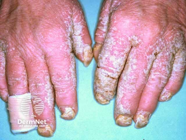 Crusted scabies with nail dystrophy