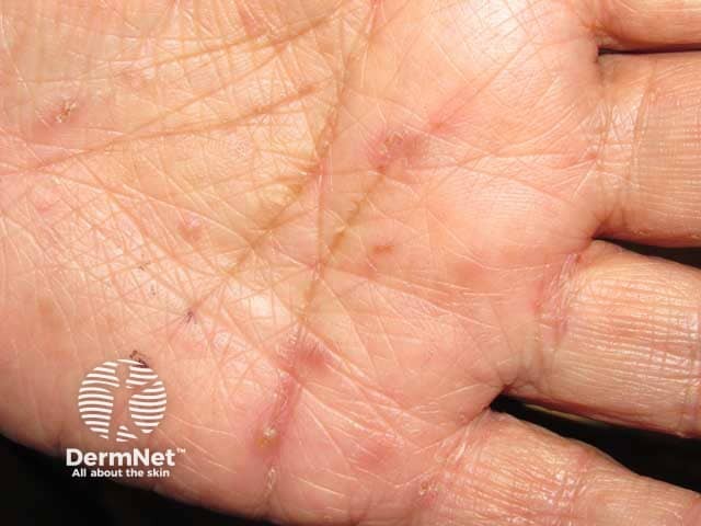 Burrows and vesicles on the palm in scabies