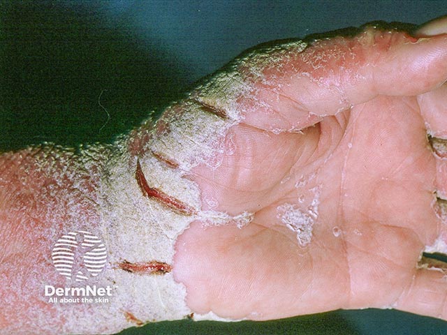 Fissuring and crusting of the wrist and thumb due to crusted scabies