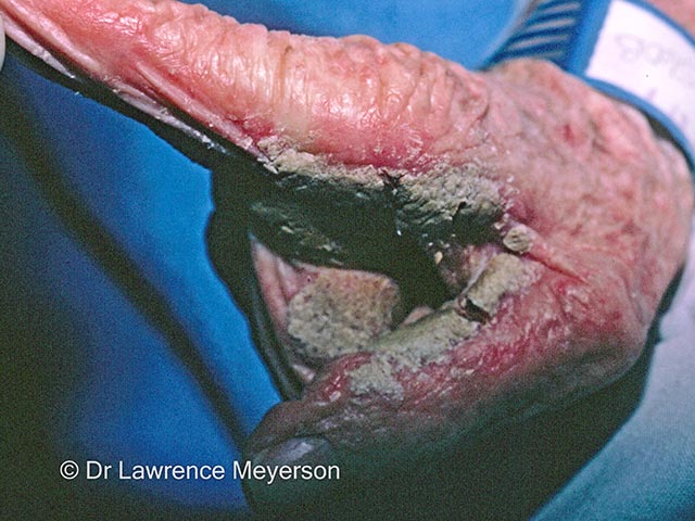 Crusting of the palmar and finger skin in crusted scabies