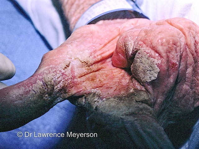 Crusting of the palmar and finger skin in crusted scabies