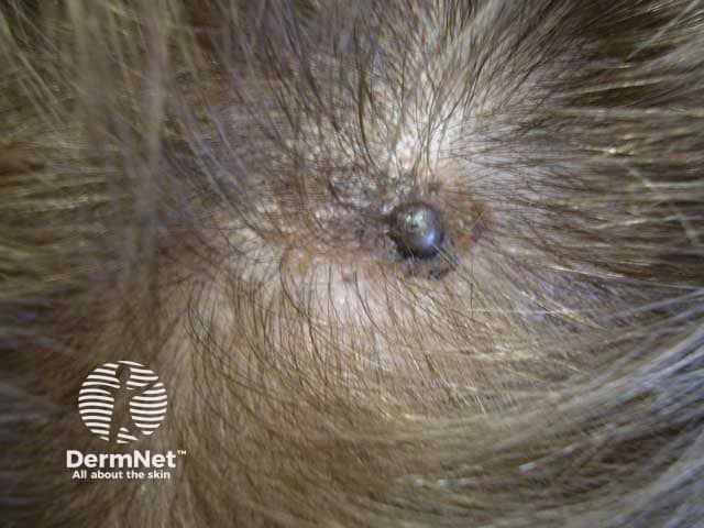 Superficial spreading malignant melanoma on the scalp with recent development of nodular component