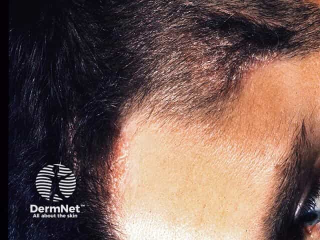 Psoriasis around the hair line 