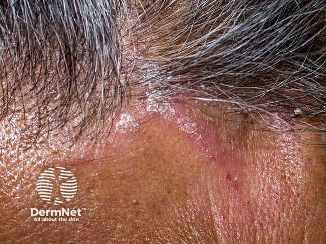 Well-circumscribed red scaly patches of psoriasis in the anterior hairline