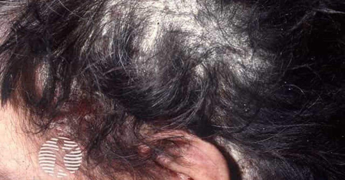 Scalp Psoriasis Image