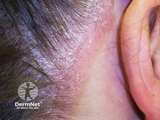 Confluent psoriasis in the scalp extending anteriorly from the hairline