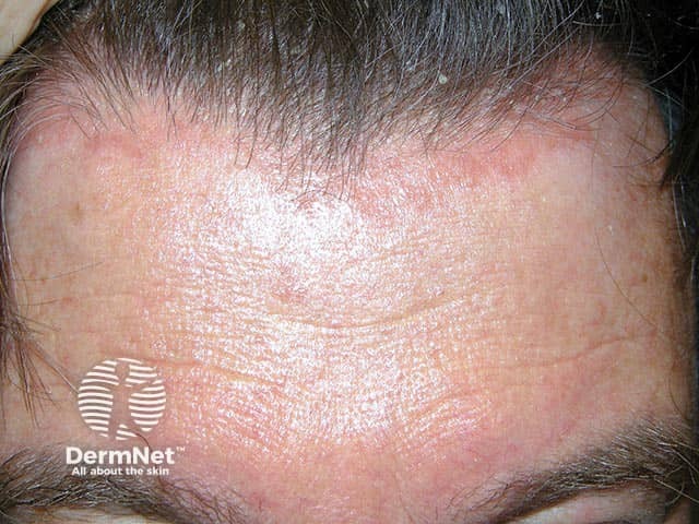 Scalp psoriasis extending beyond the anterior hairline