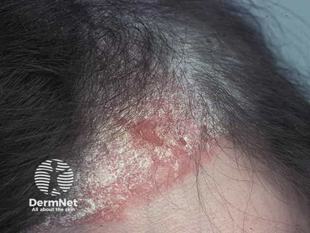 Scalp Psoriasis Images — DermNet