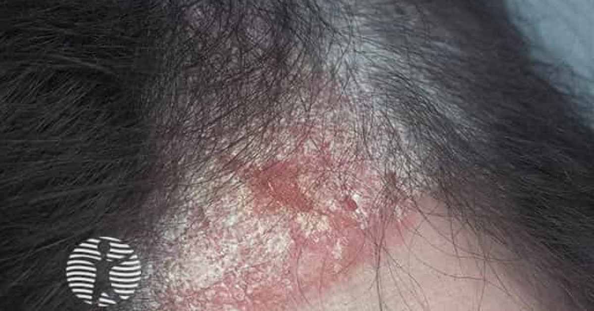 Scalp Psoriasis Image