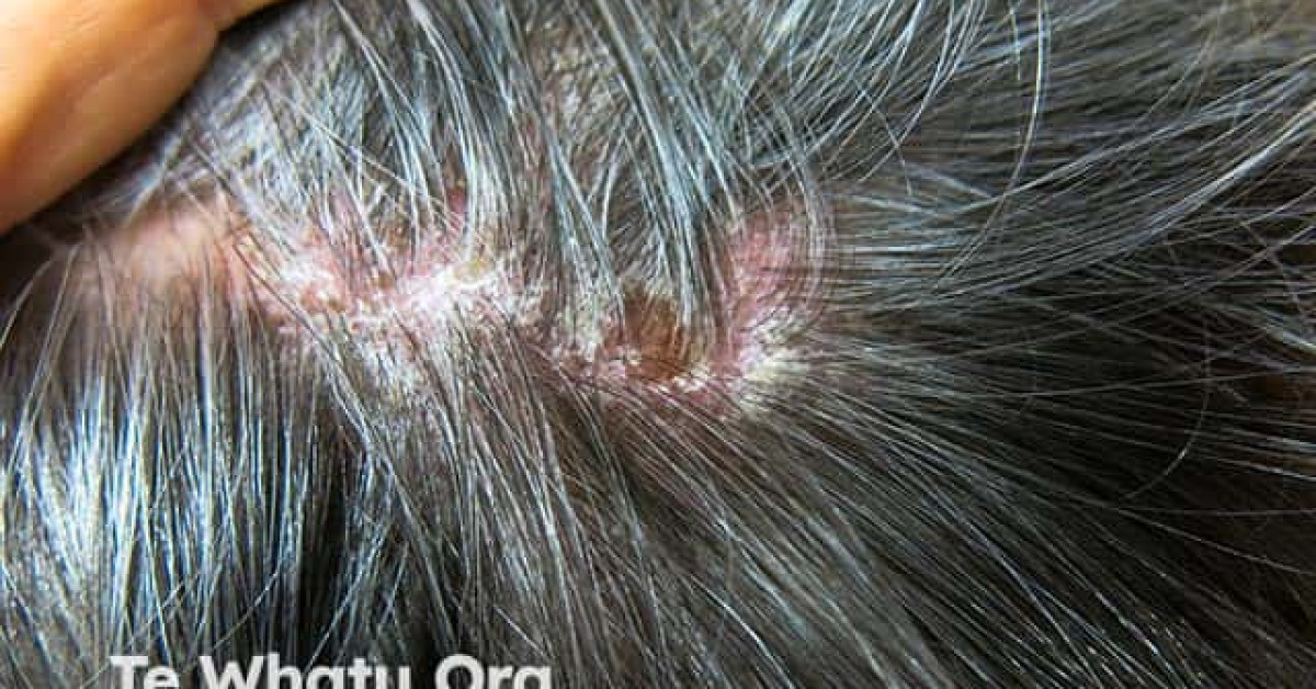 Scalp psoriasis image