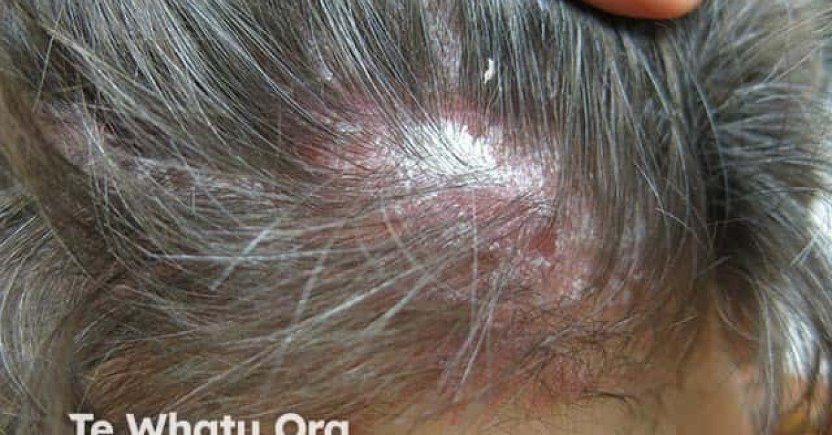 DermNet® - Scalp psoriasis image