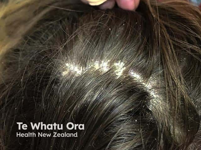 Marked thick scaling in psoriasis of the scalp