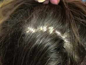 Scalp Psoriasis: A Complete Overview — DermNet