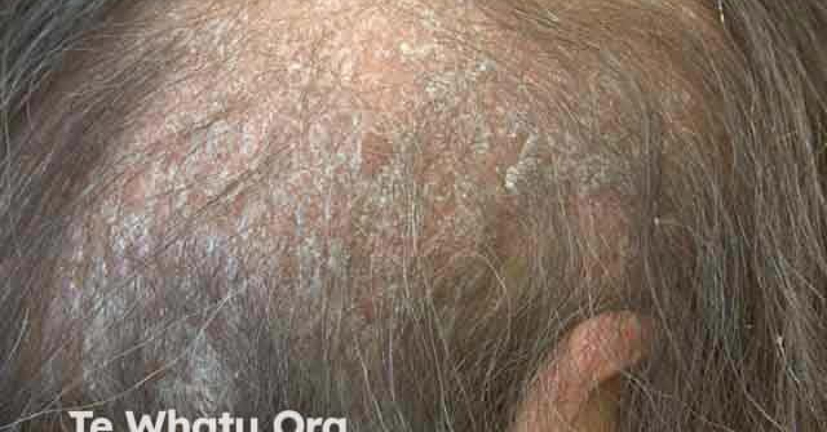 Scalp psoriasis image