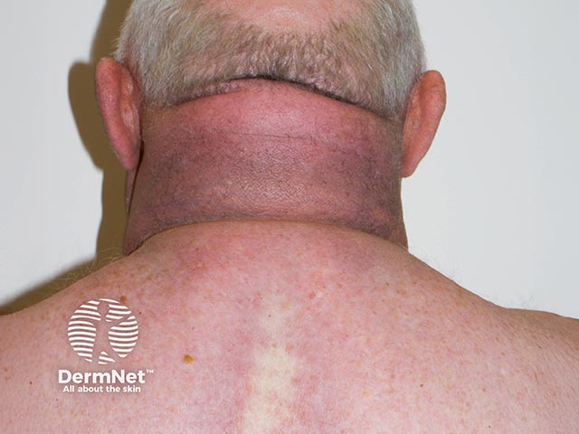 Scleredema over the upper back and neck. There was both underlying diabetes and a paraprotein