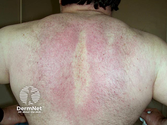 Violaceous erythema and skin thickening over the upper back due to scleredema. Pulling the shoulders back blanches the erythema in the middle of the back