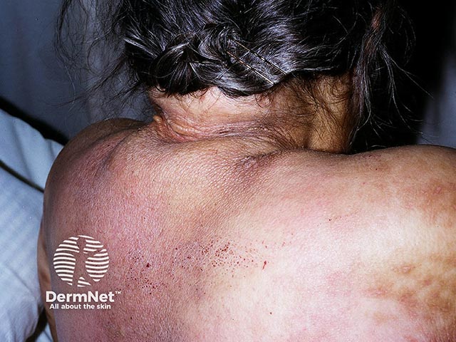 Woody induration, faint erythema, and thickening in a daibetic with scleredema