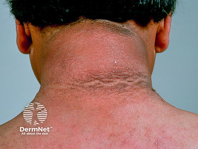 Scleredema causing thickening over the neck and back - there is also acanthosis nigricans