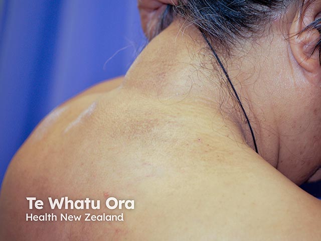 Skin thickening over the nape and upper back due to scleredema